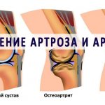 artiritis or arthrosis
