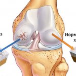 Osteoarthritis of the knee joint and normal