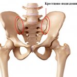 Arthrosis of the sacroiliac joint - causes of development