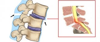 Pain due to spinal instability occurs due to radicular syndrome