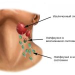 Боль в шее у ребенка часто возникает из-за воспаления лимфоузлов