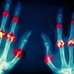 Diseases of the joints of the fingers: types, causes, symptoms and treatment