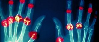 Diseases of the joints of the fingers: types, causes, symptoms and treatment
