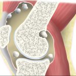 Чаще всего, в 42 % случаев, хондроматоз поражает коленный сустав