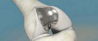 Частичный пателлофеморальный протез: Металлический имплантат на бедре между двумя бедренными мыщелками покрывает надколенниковую поверхность бедренной кости. Соединение полиэтиленового и титанового имплантата с обратной стороны надколенника образует скользящую поверхность. Наши специлиалисты цементированным имплантатам предпочитают конструкции HemiCAP.