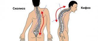 Scoliosis is often confused with kyphosis, which is extremely wrong.