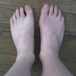 How to steam your feet for gout