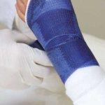 What to do if swelling and severe pain appear after removing the cast from your arm