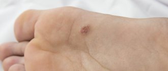 What are plantar warts and how to treat them