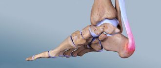 What is Achilles tendinitis?
