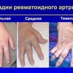 Is disability granted for rheumatoid arthritis: registration procedure and group