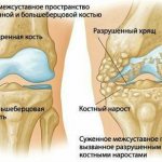 deforming arthrosis, treatment of orthrosis