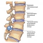 Stages of development of a spinal hernia