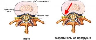 Фораминальная грыжа характеризуется выпячиванием диска в направлении нервных корешков