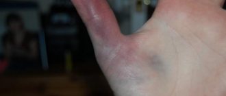 Photo: signs of a dislocated finger