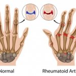 Gymnastics for arthritis of the fingers