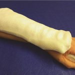 plaster splint for tibia fracture