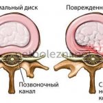 Hernia of the cervical spine