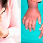 Infectious toxic-allergic arthritis
