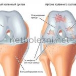 How does arthrosis develop?
