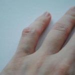 Как убрать шишку на пальце руки. Шишки на суставах пальцев рук: причины, симптомы и лечение