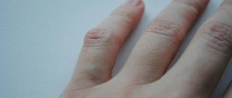 How to remove a bump on your finger. Bumps on the knuckles: causes, symptoms and treatment 