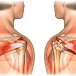 Treatment of shoulder pain