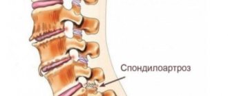 Treatment of spondyloarthrosis in Minsk - photo of spondyloarthrosis