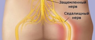 Lumboischialgia occurs due to compression of nerve endings in the lumbar spine