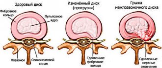 intervertebral hernia