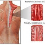 Миозит характеризуется воспалением мышечных волокон мышц