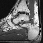 MR anatomy of the Achilles tendon