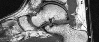 МР-анатомия ахиллова сухожилия