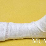 Mumiyo for fractures
