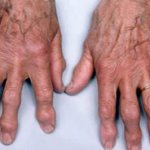 На пальце руки косточка выросла. Какие заболевания провоцируют появление шишек