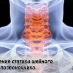 Disturbance of cervical spine statics