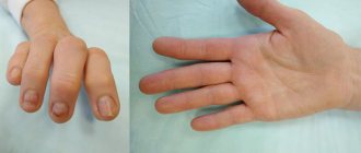 Malunion fracture of a finger