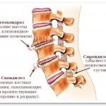 Below are the types of degenerative-dystrophic changes in the spine in the cervical region
