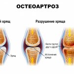 Osteoarthrosis.jpg