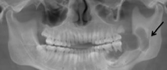 Osteomyelitis of the jaw in children