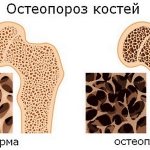 Остеопороз характеризуется потерей плотности костной ткани