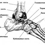 Pathological functional restructuring of the bones of the foot