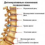 Spine pathologies