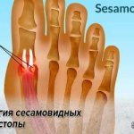 Pathology of the sesamoid bones of the foot