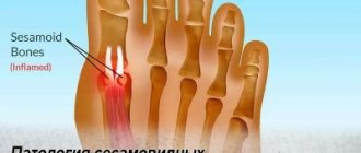 Патология сесамовидных костей стопы