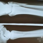 Fibula fracture - lower limb injury