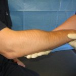 Forearm fracture: symptoms, treatment, rehabilitation