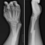 Displaced arm fracture