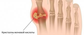Gout Image 1 Network of clinics JSC Family Doctor