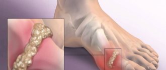 Gout: symptoms and treatment
